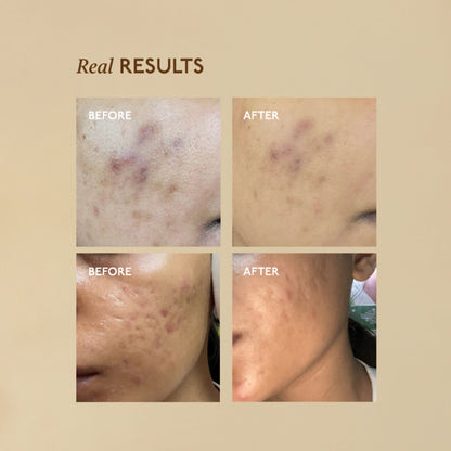 Asaya Advanced Dark Spot Pigmentation Face Serum for Men & Women with MelaMe Complex & Niacinamide