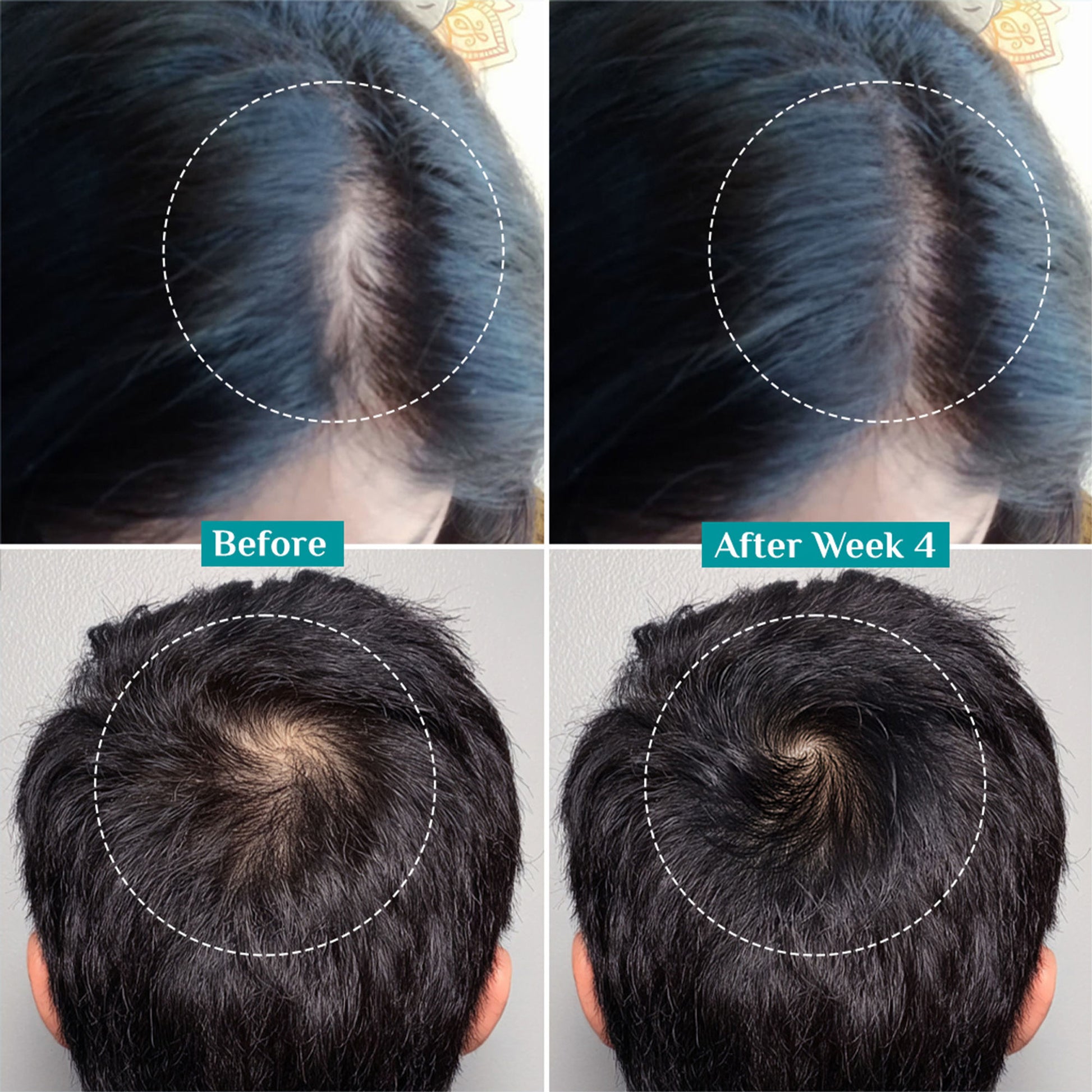 Pilgrim 3% Redensyl 4% Anagain Rosemary Korean Black Rice Advance Hair Growth Serum For Men & Women