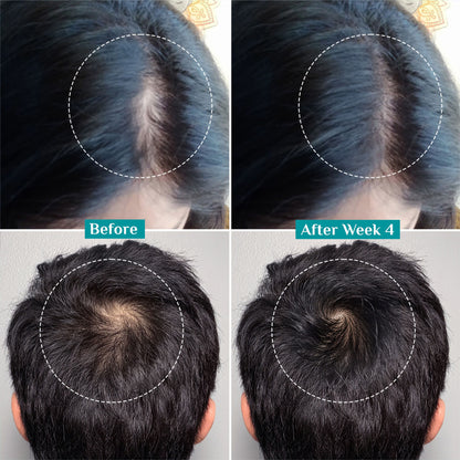 Pilgrim 3% Redensyl 4% Anagain Rosemary Korean Black Rice Advance Hair Growth Serum For Men & Women