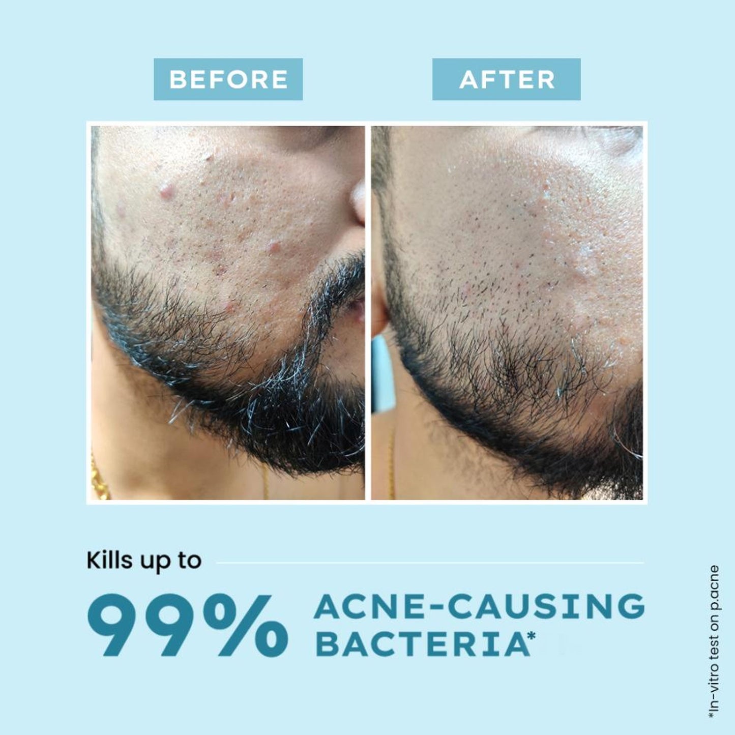 Hyphen Clarifying Acne Cleanser With 2% Salicylic Acid, Anti-Acne Face Wash For Oil Control