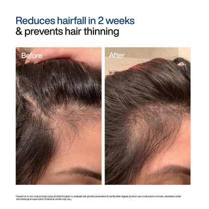Wishcare Hair Growth Serum Concentrate with Redensyl & Rosemary - In-Vivo Tested - Controls Hairfall