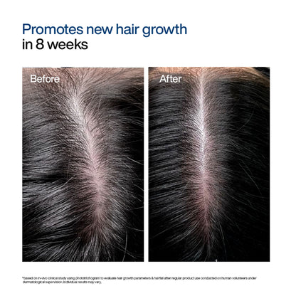 Wishcare Hair Growth Serum Concentrate with Redensyl & Rosemary - In-Vivo Tested - Controls Hairfall