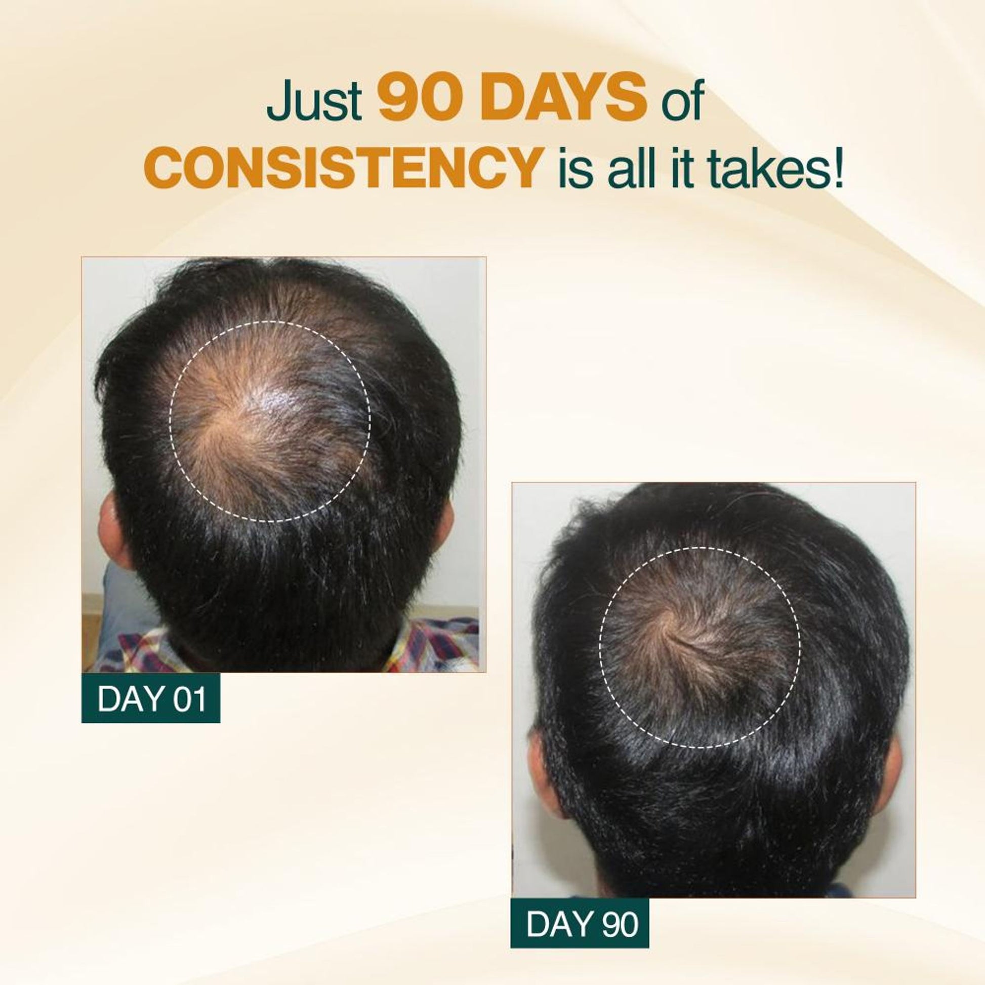 Nourish Mantra Advanced Hair Growth Serum With Rosemary Oil for Hair Regrowth and Stop Hairfall