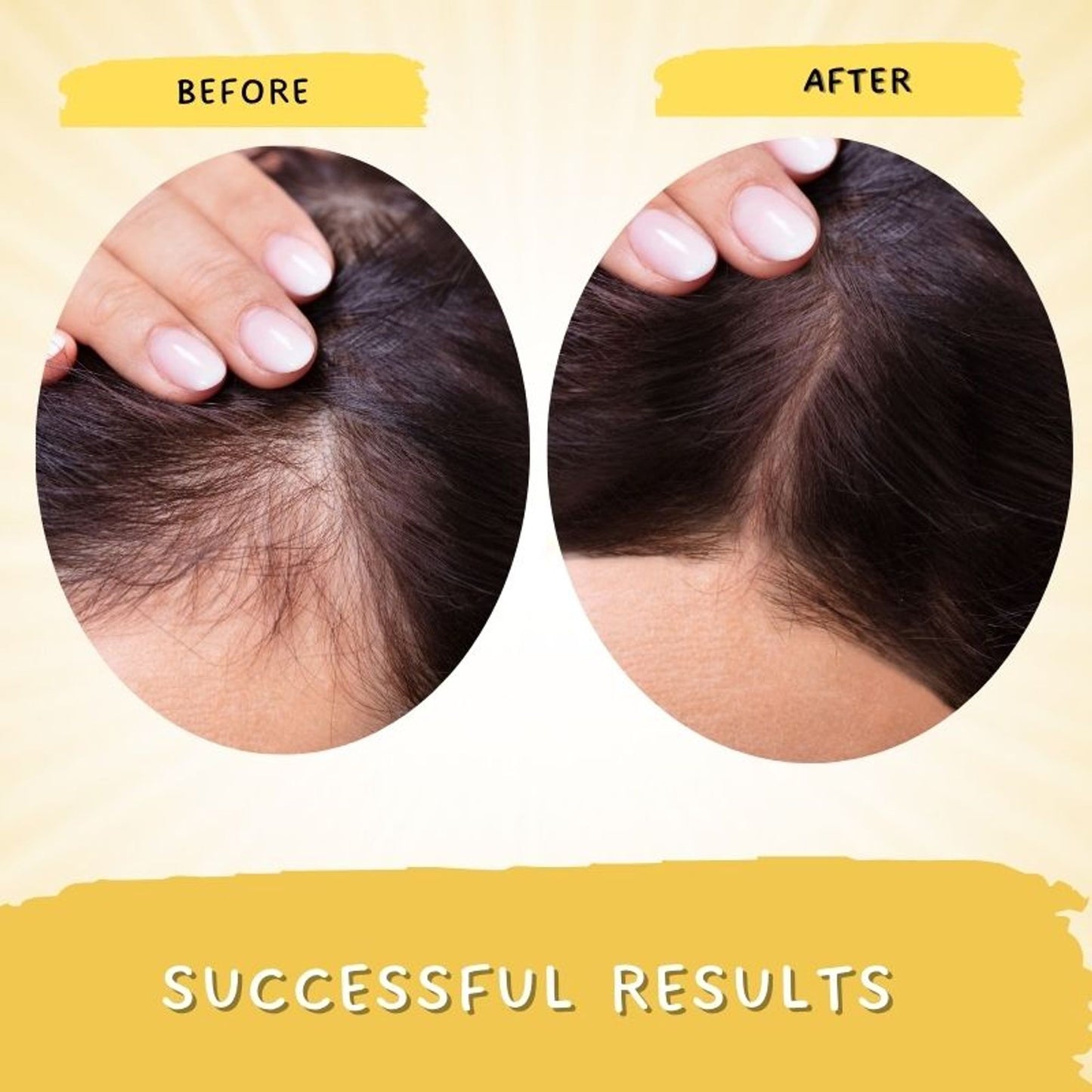 Mystiq Living Rosemary Hair Growth Serum For Scalp With Redensyl Keratin For Men & Women