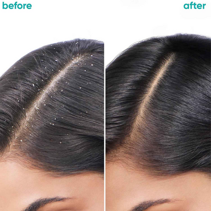 Matrix Biolage Scalppure anti-dandruff shampoo and conditioner bottles, moisturizing hair care for scalp health