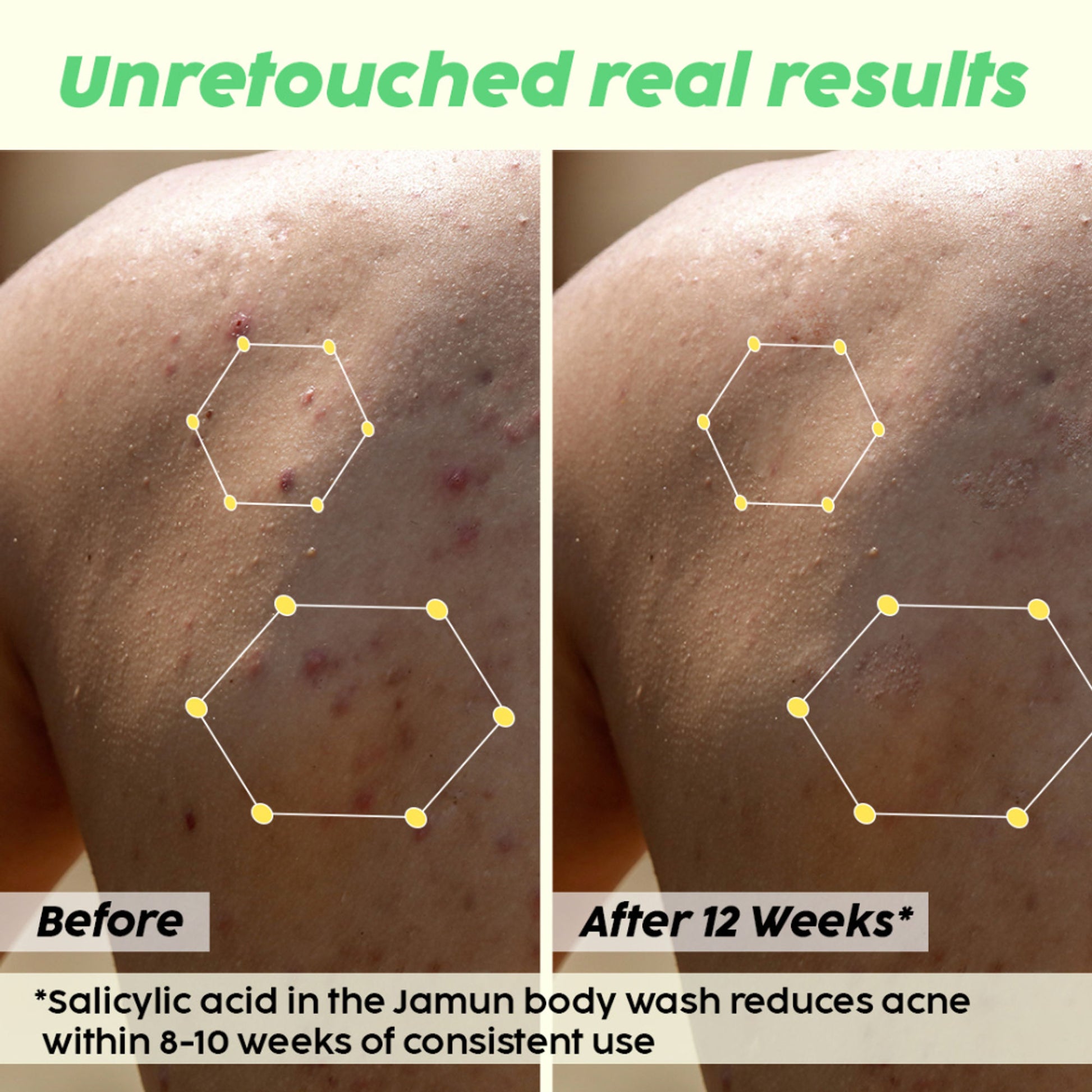 Plix 2% Salicylic Acid Body Wash For Body Acne, Deeply Exfoliating Dead Skin Cells, Moisturizes Skin