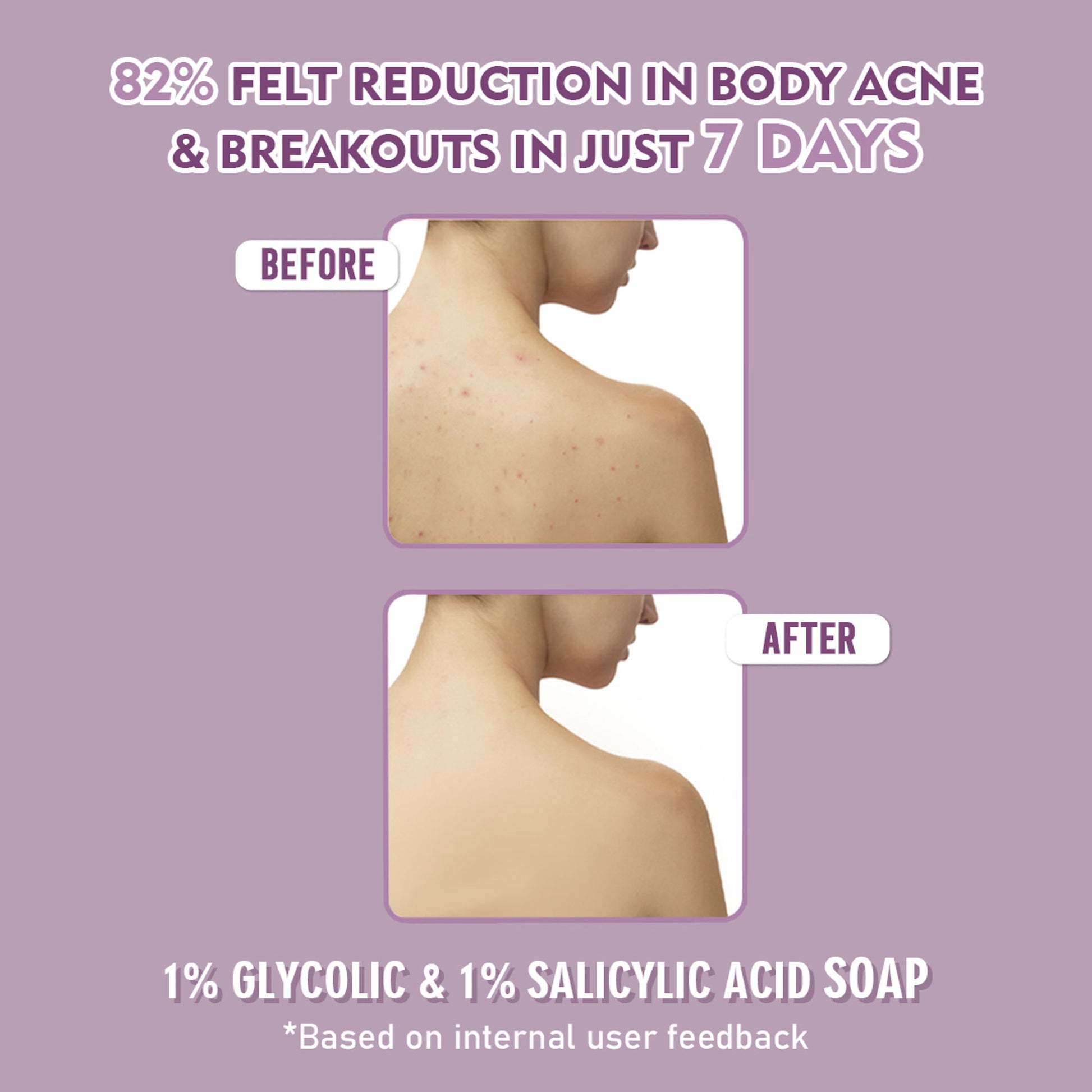 Glamveda 1% Glycolic Acid & 1% Salicylic Acid Body Acne Soap