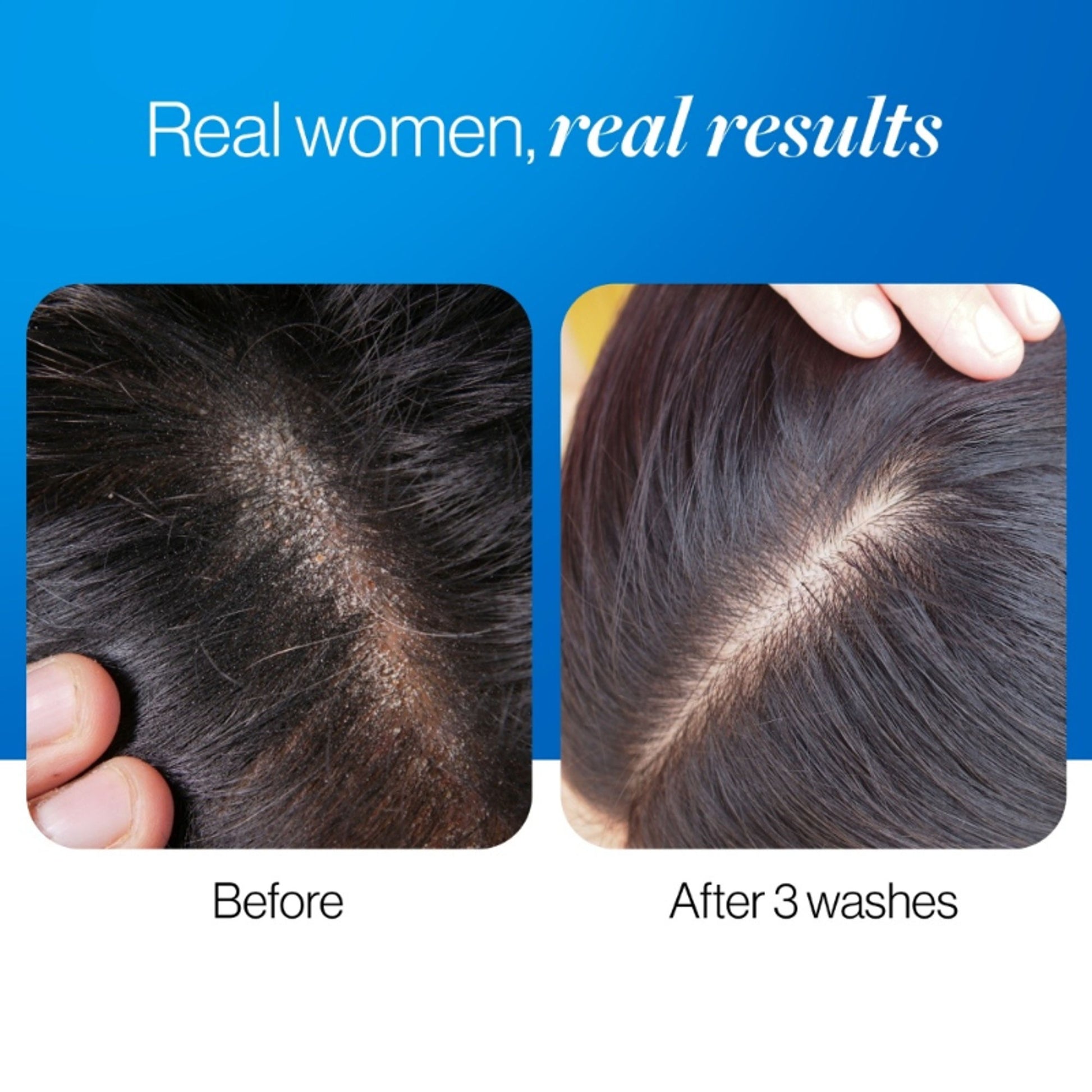 Be Bodywise ZPTO Anti Dandruff Shampoo - Reduces Dandruff, Flaking & Deeply Hydrates Scalp