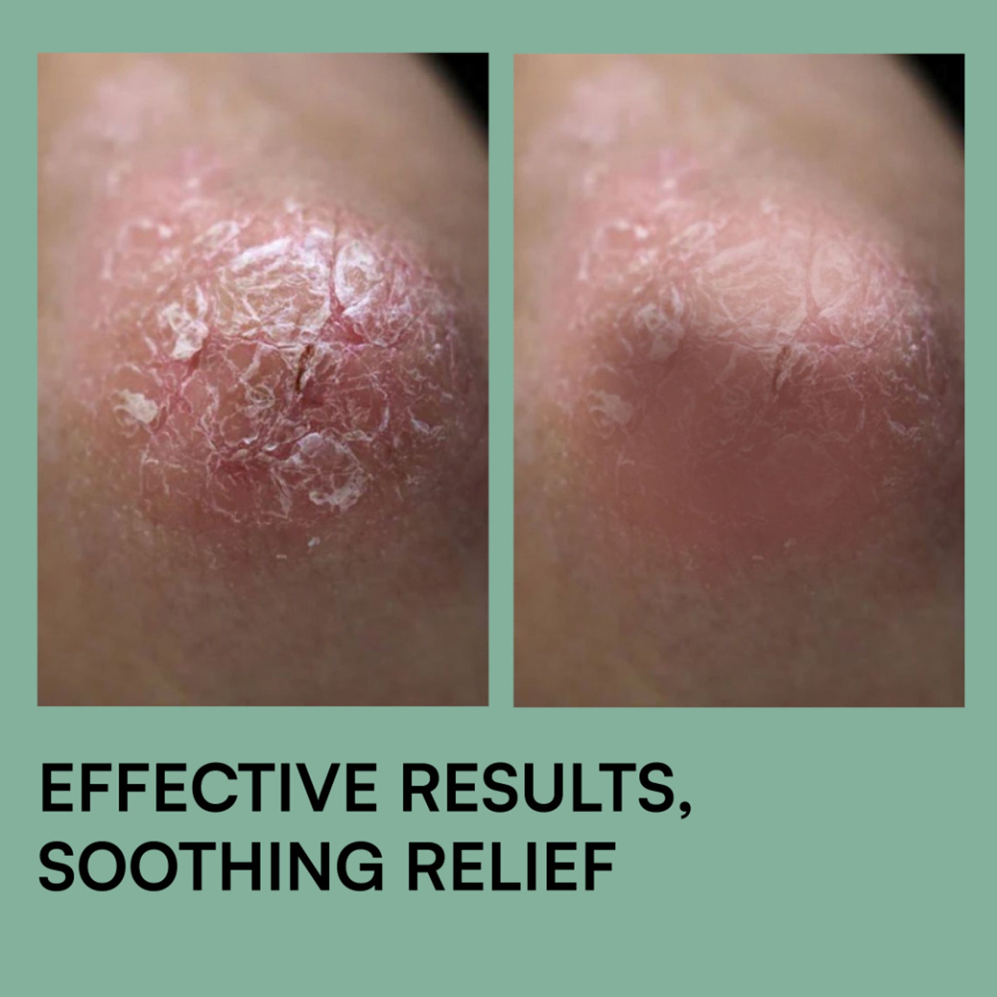 Brinton Psoramist Moisturizing Cream