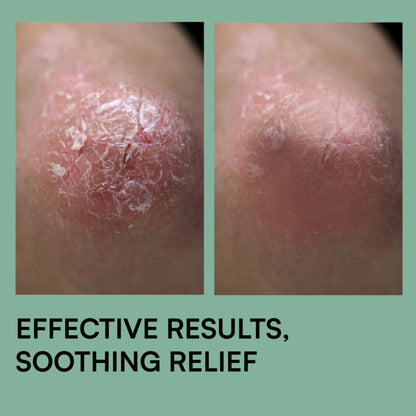 Brinton Psoramist Moisturizing Cream