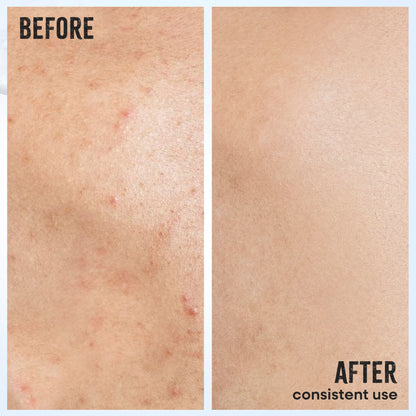 Nykaa 1% Salicylic Acid & Lactic Acid Exfoliating Body Wash - Treats Body Acne & Strawberry Skin