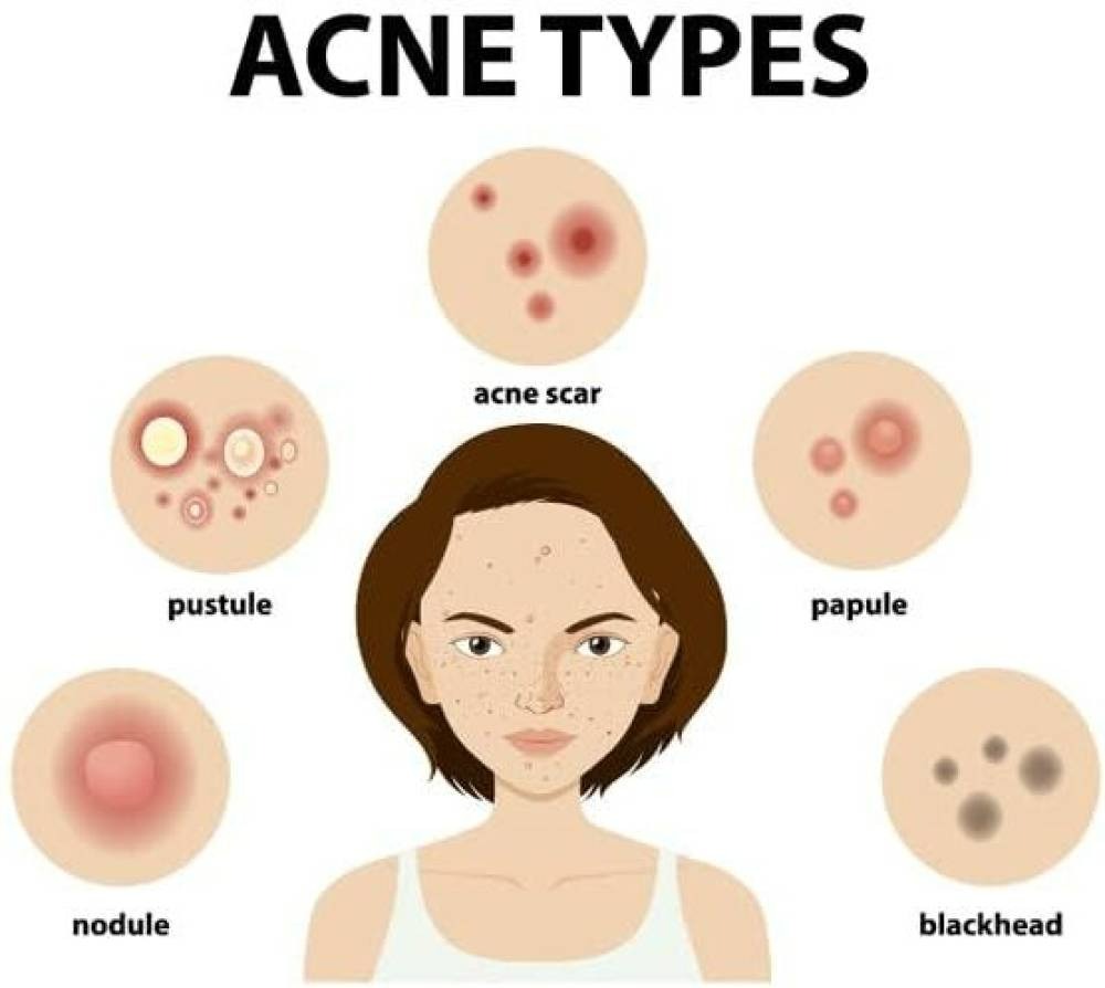 Ipca Acne UV Gel SPF 50 - Indyancart