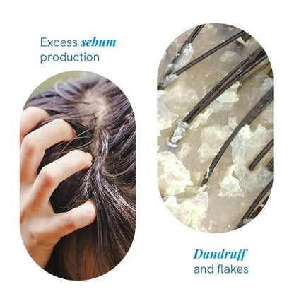 BeBodywise 1% Ketoconazole Dandruff Shampoo For Smooth & Frizz Free Hair