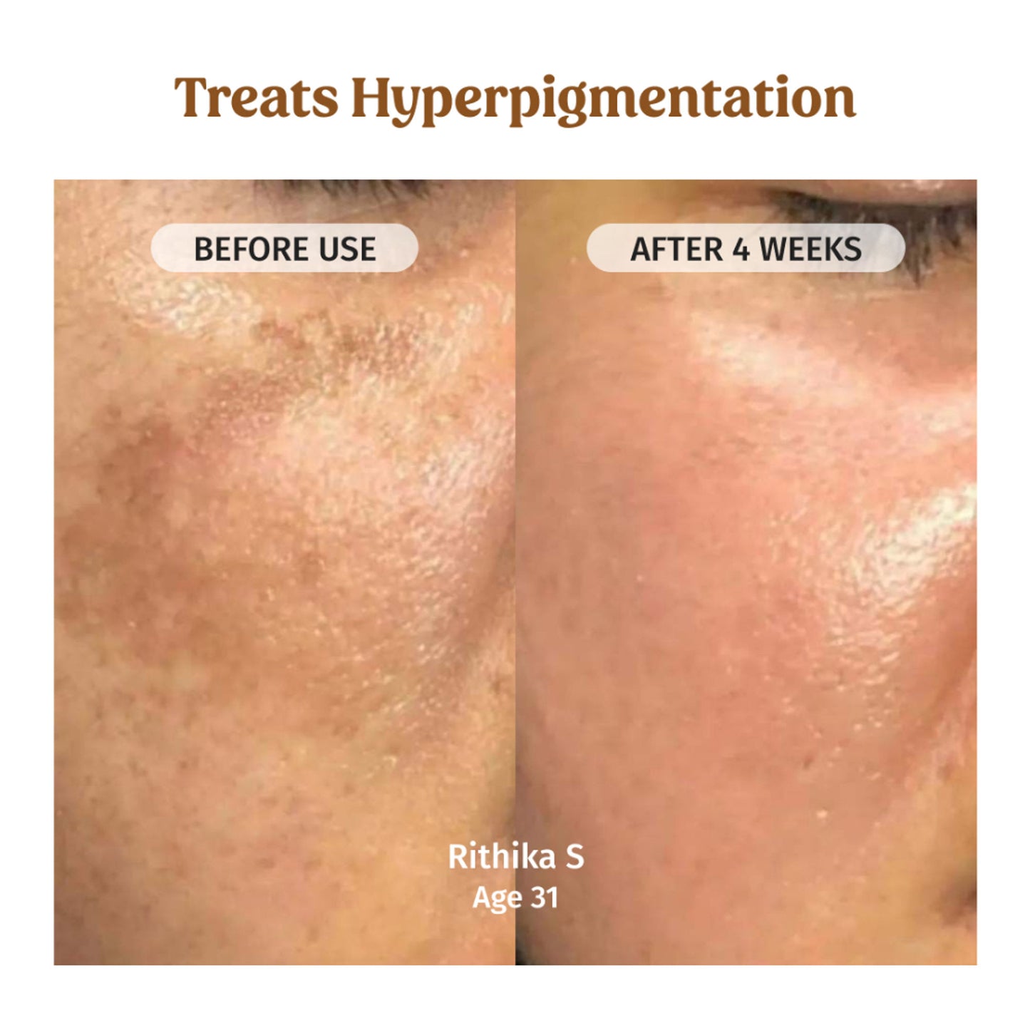 Vilvah Milk Drops Brightening Serum For Hydrated Skin, Dark Spot Care & Hyperpigmentation