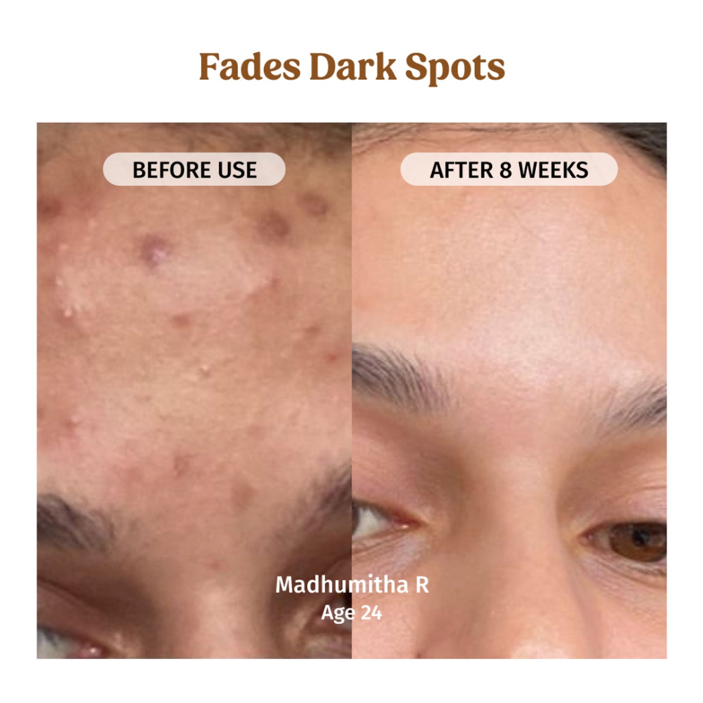Vilvah Milk Drops Brightening Serum For Hydrated Skin, Dark Spot Care & Hyperpigmentation