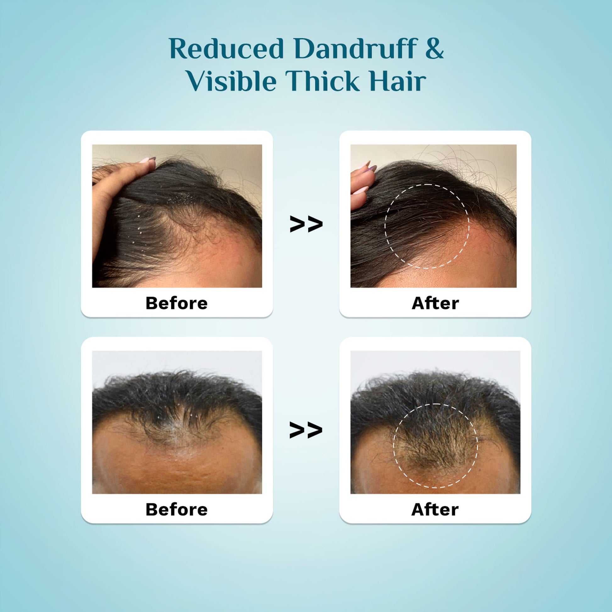 Pilgrim 3% Redensyl & 4% Anagain Advance Hair Growth Serum With Seascalp For Dandruff Prone Scalp