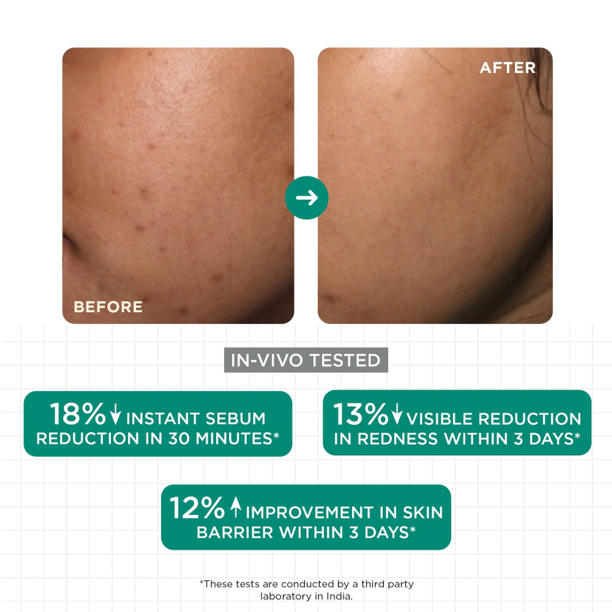 SKINQ Acne & Oil Control Serum