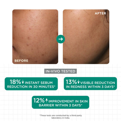 SKINQ Acne & Oil Control Serum