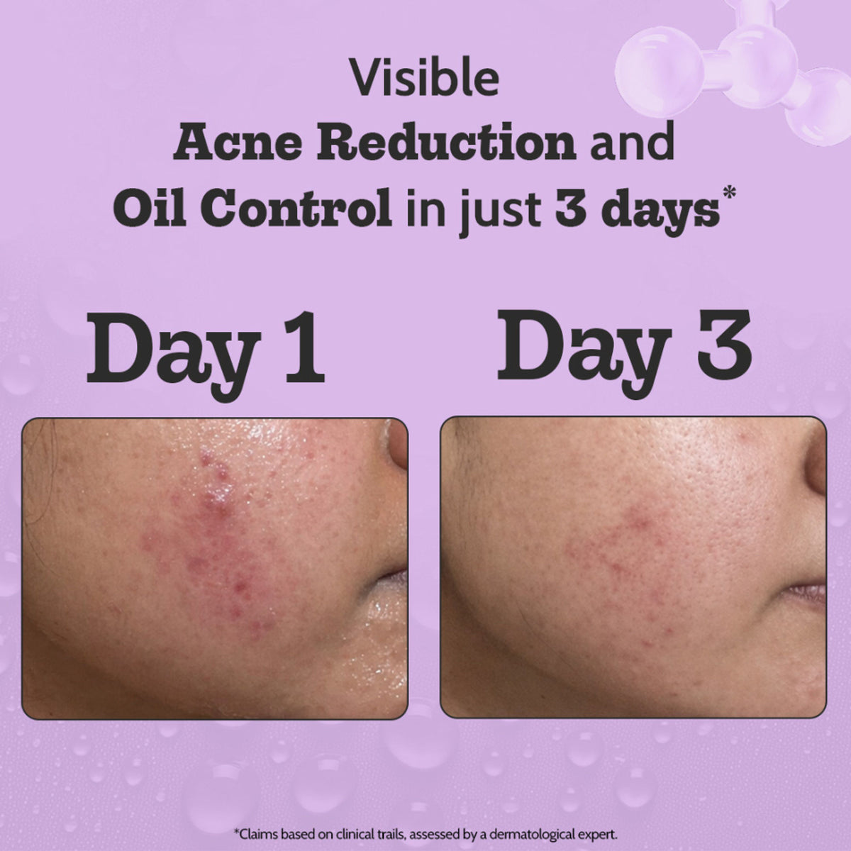 Chemist at Play 2% Salicylic Acid face serum bottle with dropper, designed for active acne and excess oil control.