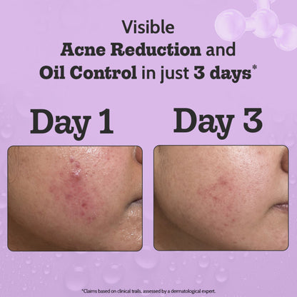 Chemist at Play 2% Salicylic Acid face serum bottle with dropper, designed for active acne and excess oil control.