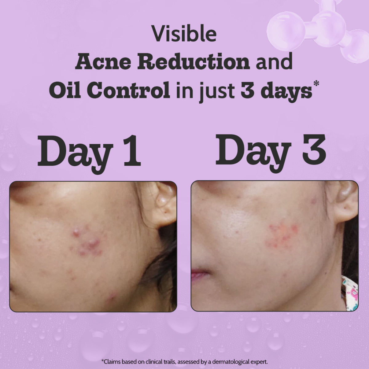 Chemist at Play 2% salicylic acid face serum for acne treatment and oil control, featuring a sleek bottle with dropper applicator.