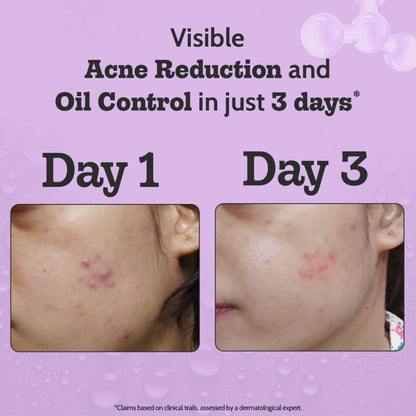 Chemist at Play 2% salicylic acid face serum for acne treatment and oil control, featuring a sleek bottle with dropper applicator.