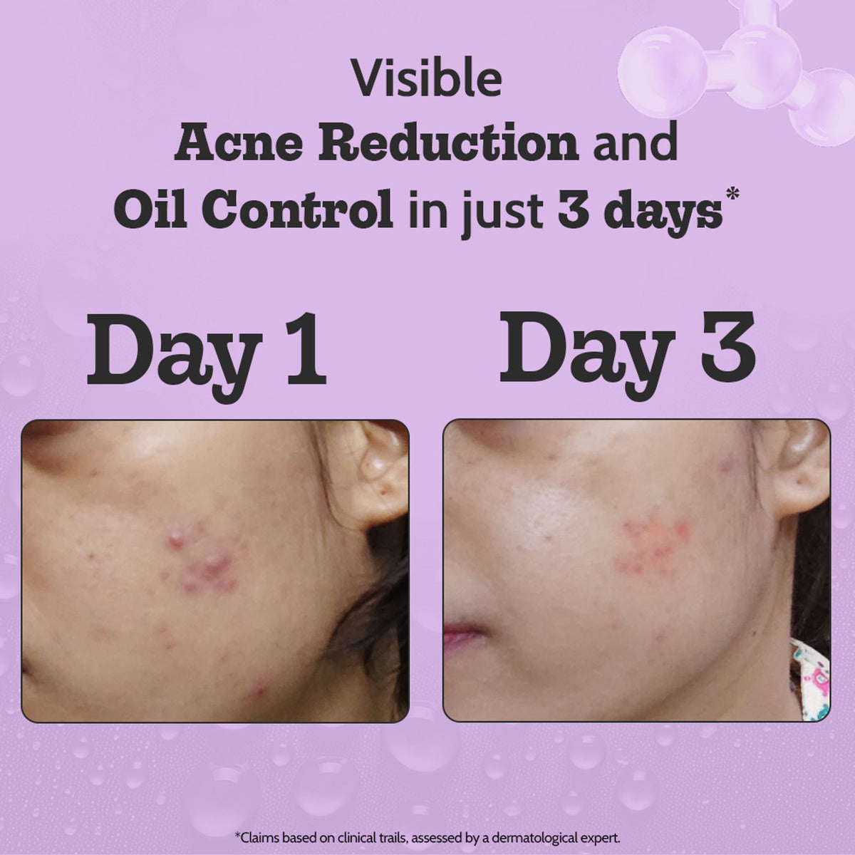 Chemist at Play 2% Salicylic Acid face serum in a dropper bottle, designed to treat active acne and control excess oil on the skin