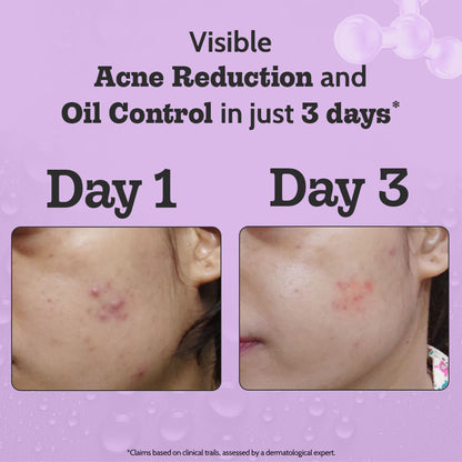 Chemist at Play 2% Salicylic Acid face serum in a dropper bottle, designed to treat active acne and control excess oil on the skin