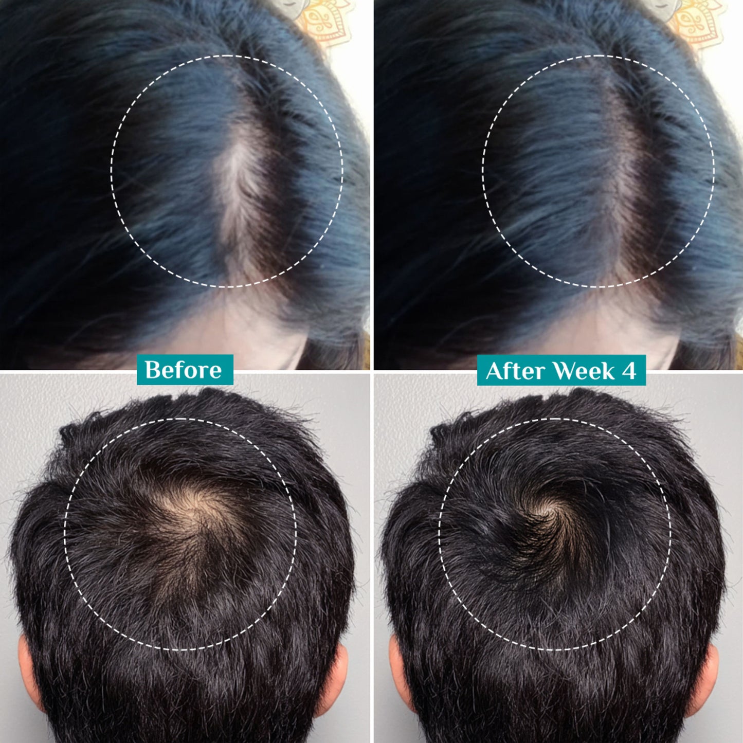 Pilgrim 3% Redensyl & 4% Anagain Advance Hair Growth Serum Roll-On With Rosemary & Korean Black Rice