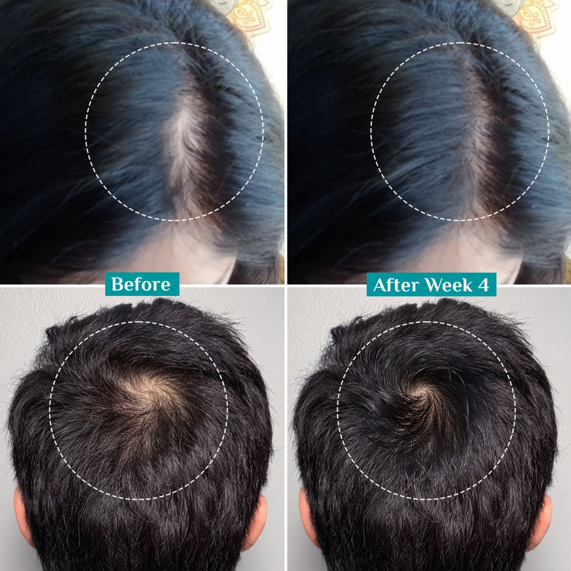 Pilgrim 3% Redensyl & 4% Anagain Advance Hair Growth Serum Roll-On With Rosemary & Korean Black Rice