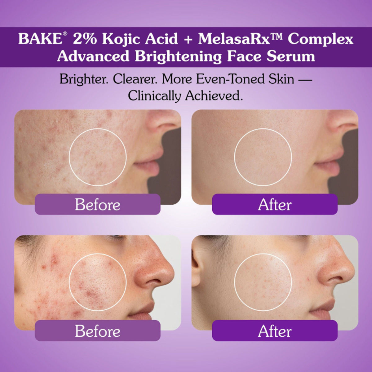 BAKE Kojic Acid face serum with niacinamide for pigmentation, dark spots, and uneven skin tone, shown in a clear dropper bottle.