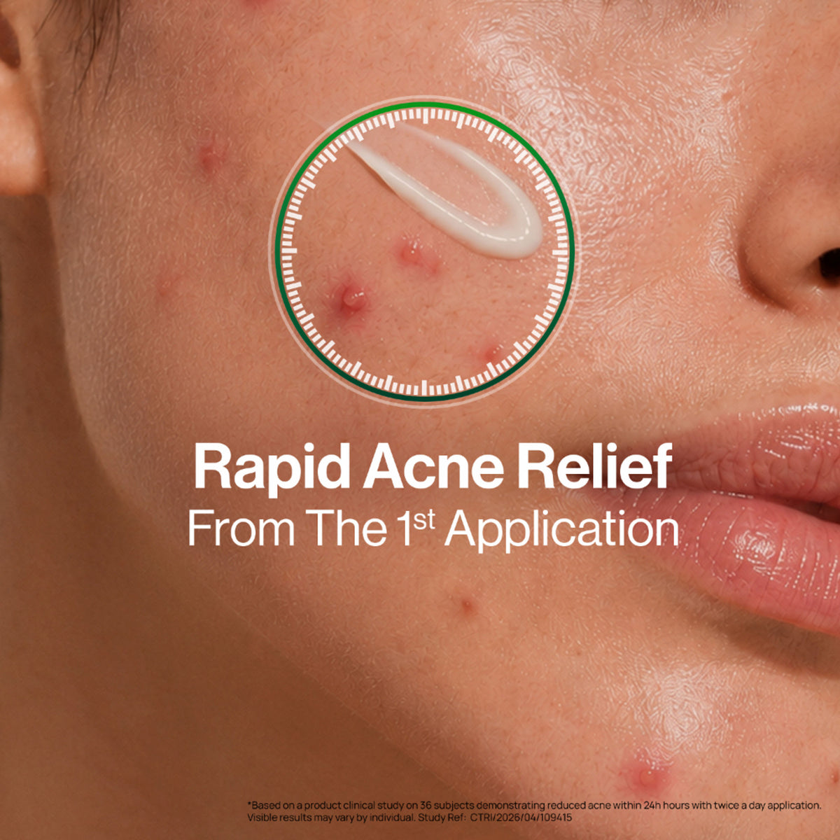 OZiva Acne Spot Corrector Reduces Pimples in 24 Hours, No Dryness & Salicylic Acid