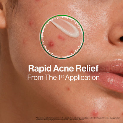 OZiva Acne Spot Corrector Reduces Pimples in 24 Hours, No Dryness & Salicylic Acid