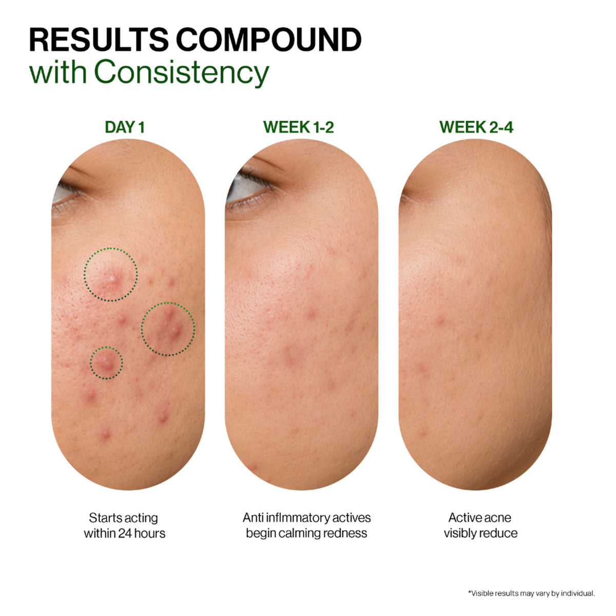 OZiva Acne Spot Corrector Reduces Pimples in 24 Hours, No Dryness & Salicylic Acid