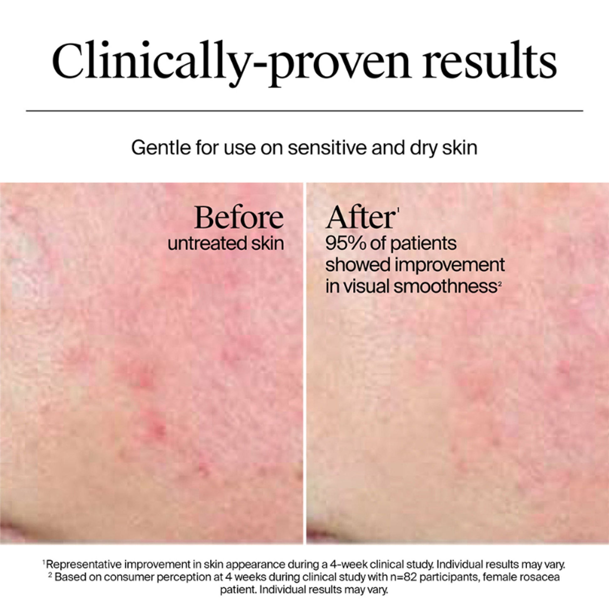 Neutrogena Hydro Boost Nourishing Cream Moisturizer with Hyaluronic Acid + Ceramides For Dry Skin