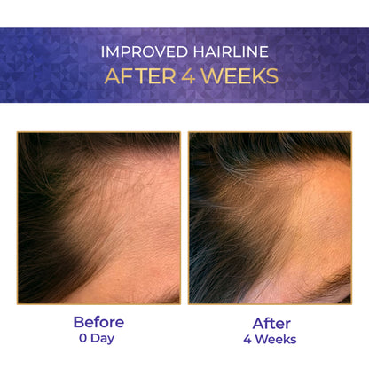 Streax Vitagrowth Hair Growth Serum with 3% Redensyl, 3% Anagain, 3% Baicapil, Biotin & Caffeine