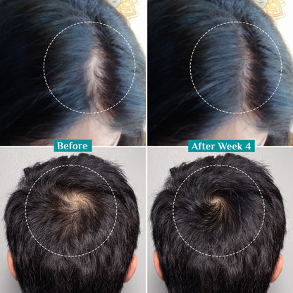 Pilgrim 3% Redensyl 4% Anagain Rosemary Korean Black Rice Advance Hair Growth Serum For Men & Women