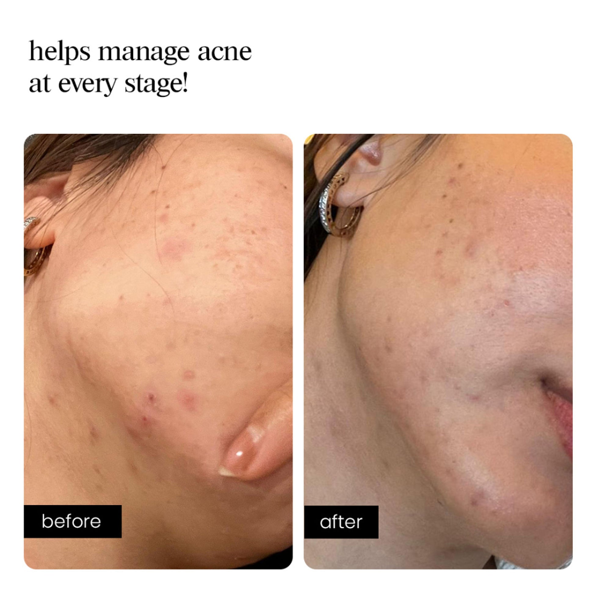 Aminu Clarifying Concentrate -Acne, Breakouts,Redness, Oil Control -Niacinamide, Azelaic, Probiotics