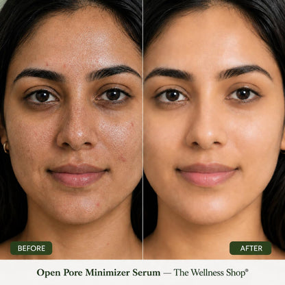 The Wellness Shop Open Pore Minimizer Face Serum for Oily & Acne Prone Skin, Reduce Dark Spot