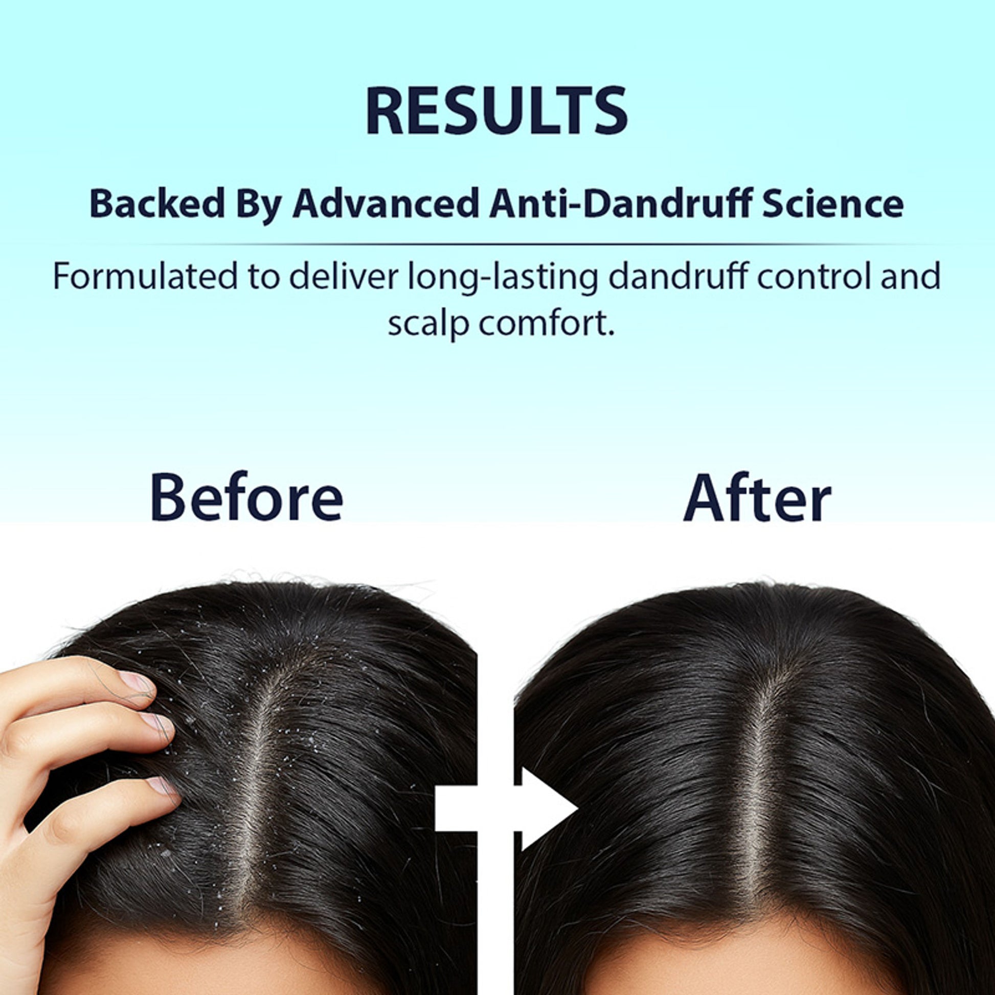 DERMISTRY Anti Dandruff Hair Serum Piroctone Climbazole Salicylic Acid For Flakes Dry Itchy Scalp