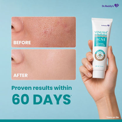 Venusia Acne Control Moisturizer| Oily Skin Friendly| Lightens Acne Scars|75g