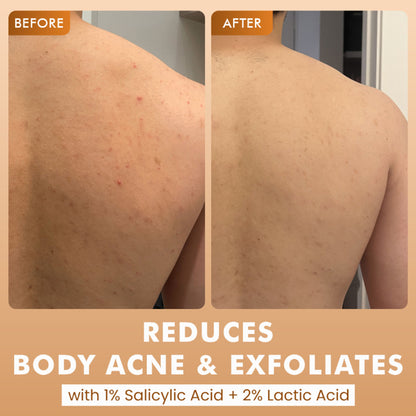 mCaffeine 7%Exfoliating Caramel Crunch Body Wash-1%Salicylic 2%LacticAcidShowerGeltoReduceBodyAcne