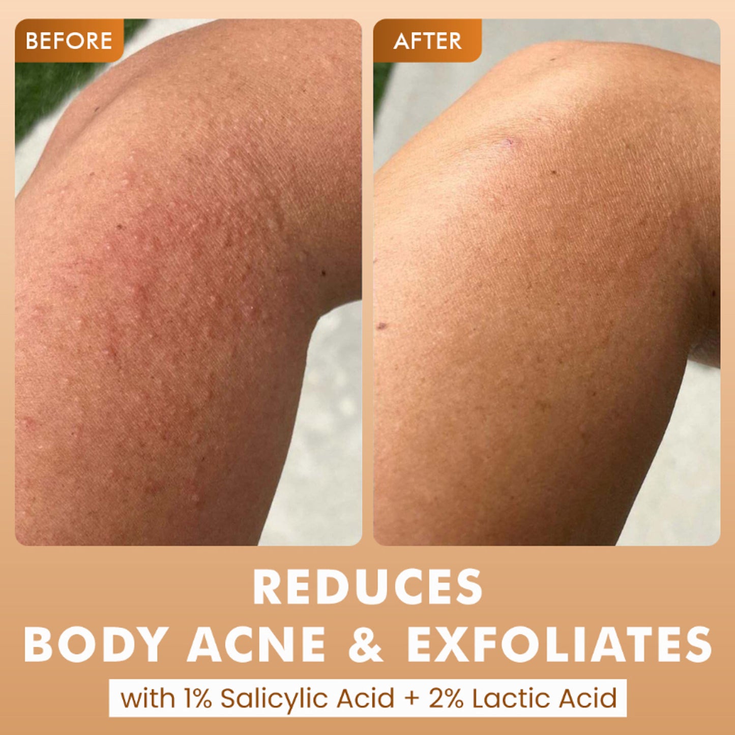 mCaffeine 7%Exfoliating Caramel Crunch Body Wash-1%Salicylic 2%LacticAcidShowerGeltoReduceBodyAcne