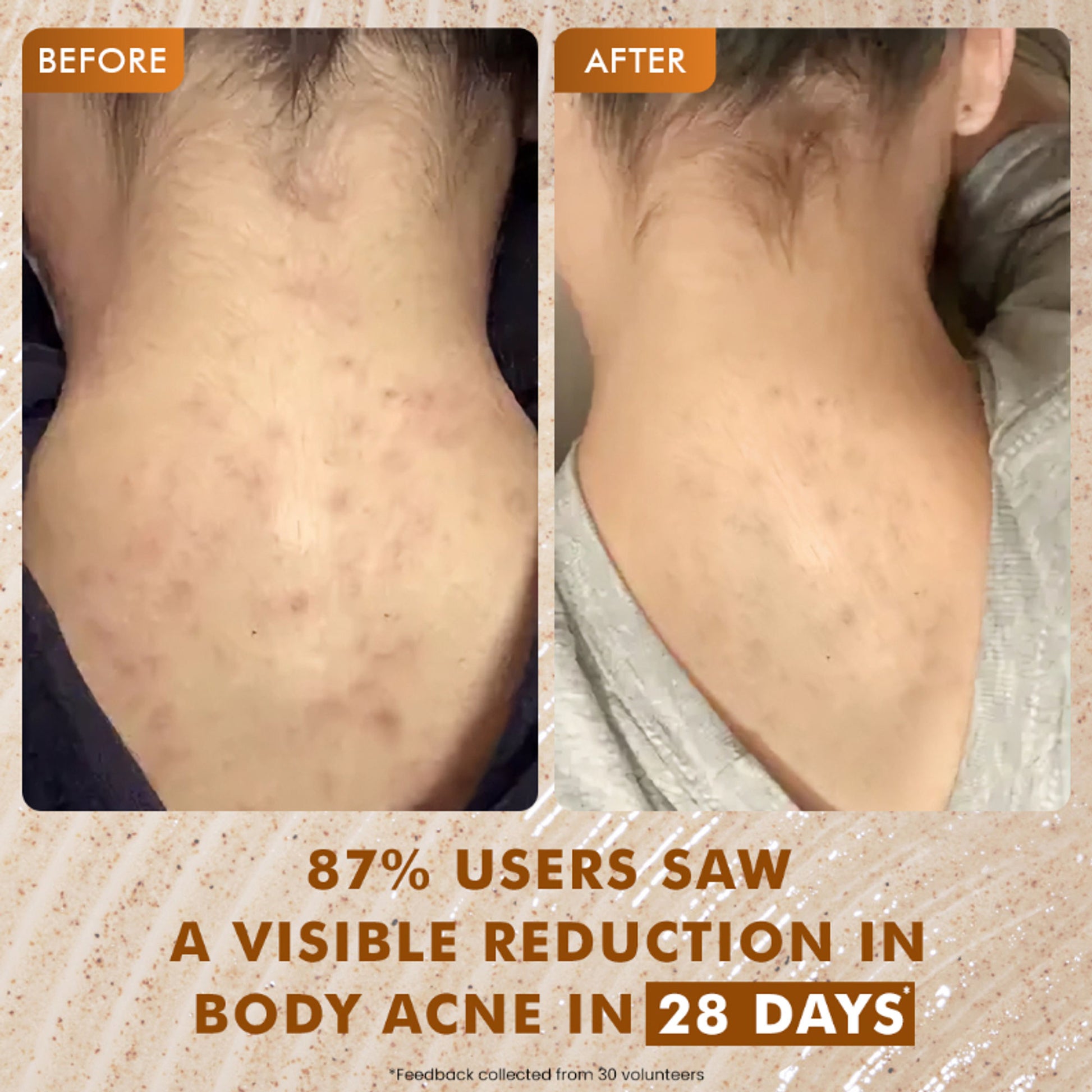 mCaffeine 7%Exfoliating Caramel Crunch Body Wash-1%Salicylic 2%LacticAcidShowerGeltoReduceBodyAcne