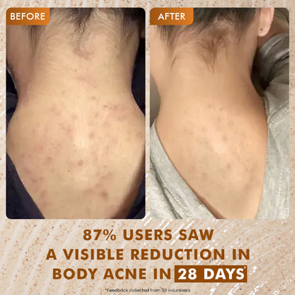 mCaffeine 7%Exfoliating Caramel Crunch Body Wash-1%Salicylic 2%LacticAcidShowerGeltoReduceBodyAcne