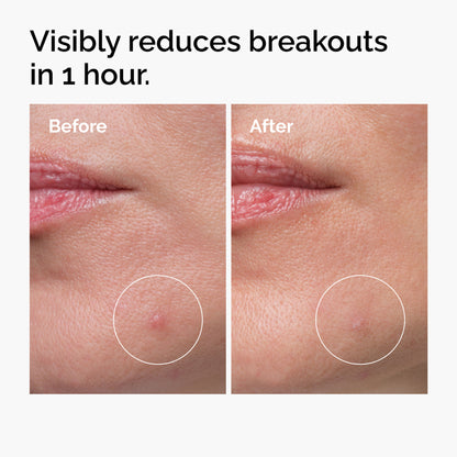 The Ordinary Sulfur 10% Powder-to-Cream Concentrate - Acne Spot Correction for Sensitive Skin