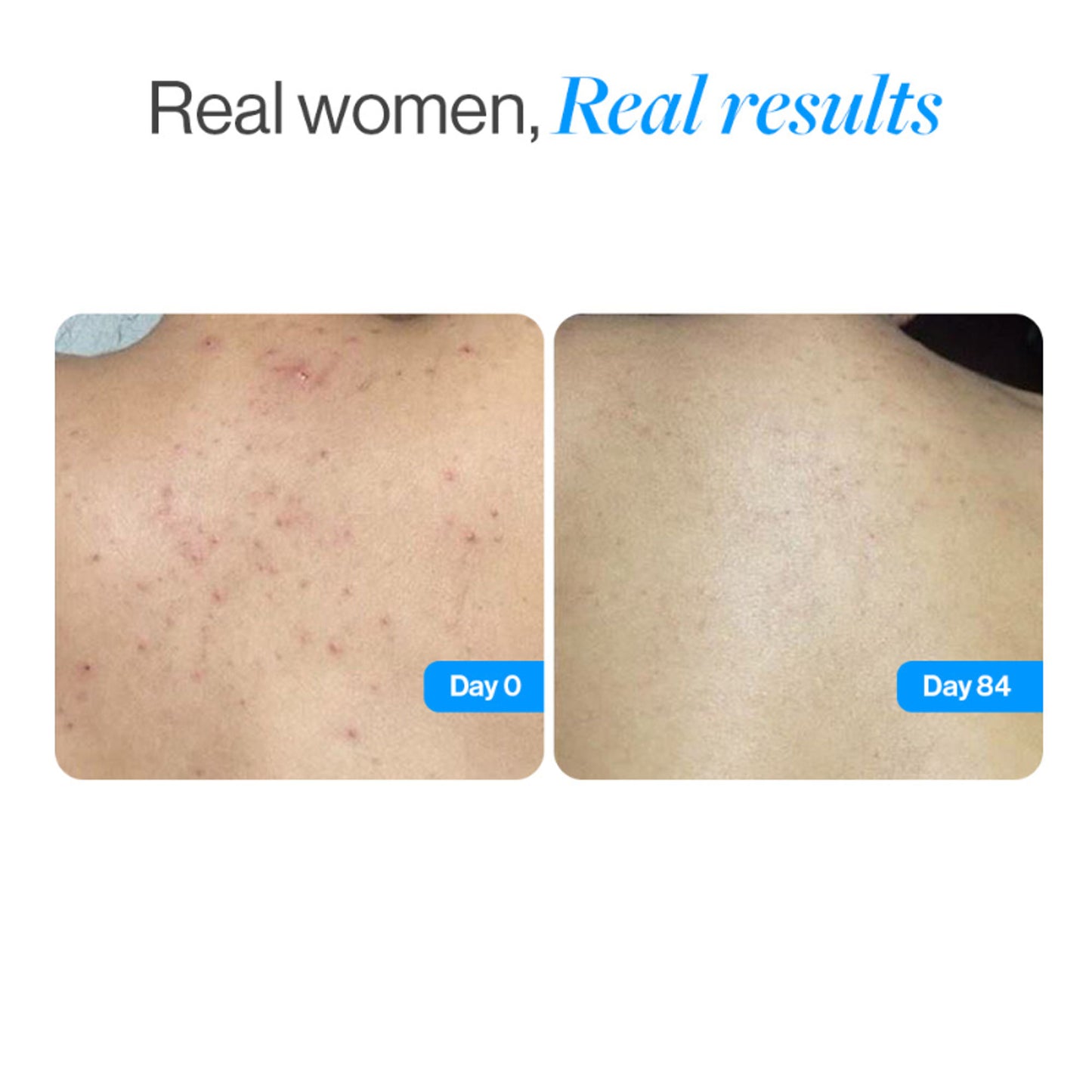 Be Bodywise 1% Salicylic Ceramide Body Wash - Dual Pump 2in1 Body Wash - For Body Acne and Dry Skin
