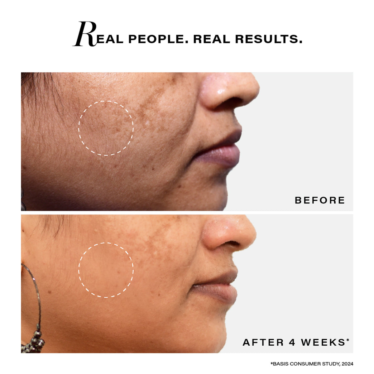 Novology Bi-Phasic Serum for Hyperpigmentation, Dark Spots, Blemishes and Acne Marks, Dermat Tested