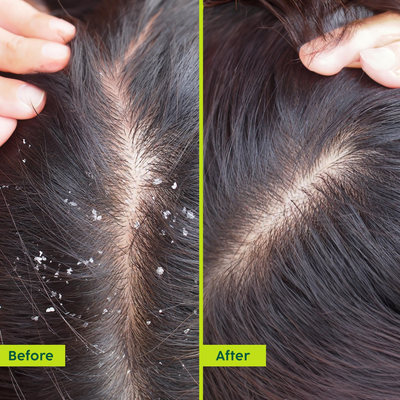 PLIX The Plant Fix Neem Anti-Dandruff Advanced Hair Serum For Reduce Dandruff & Inflammation